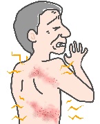 帯状疱疹・ヘルペス